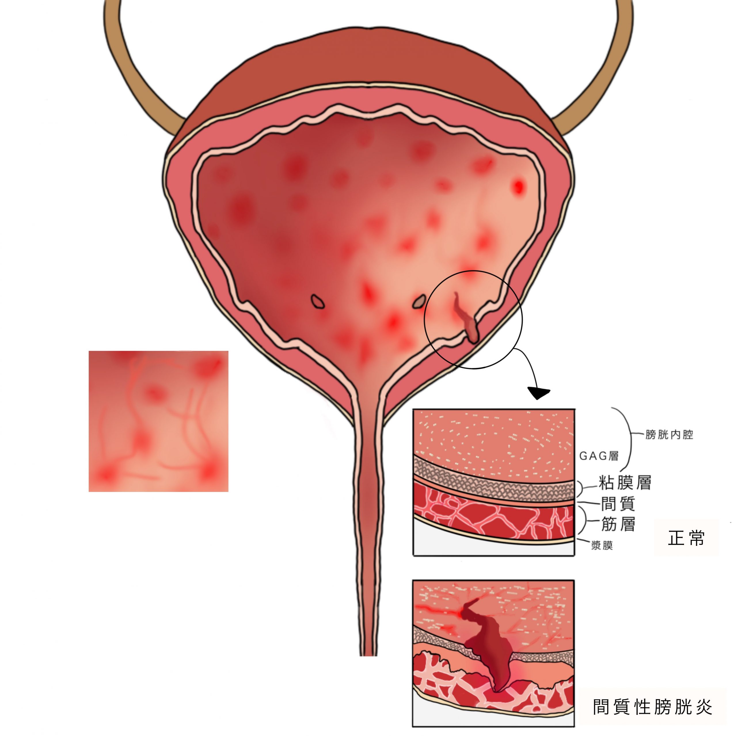 陰道炎、尿道炎、膀胱炎 女性3種常見炎症成因與徵狀 置之不理或引發不育、宮外孕等併發症？ - 明報健康網